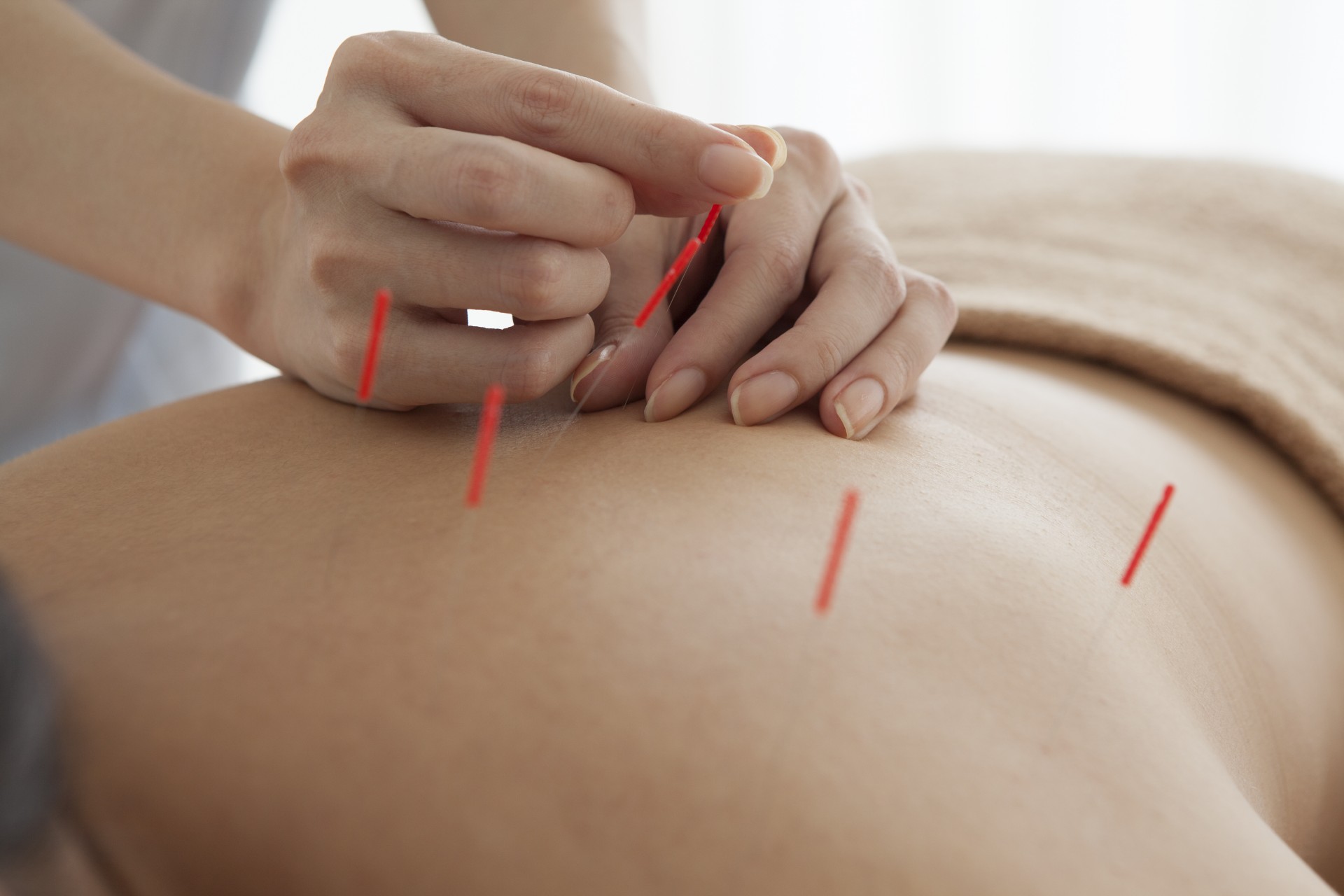 acupuncture Featured Image